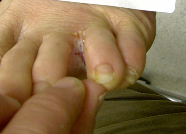 Mycose du pied (pied d'athlÃ¨te)