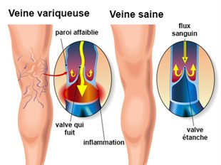 Jambes lourdes